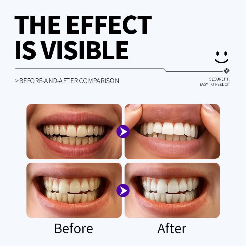 Whitening Strips